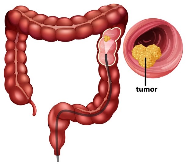 Ilustração de intestino grosso com destaque para tumor (Câncer colorretal)